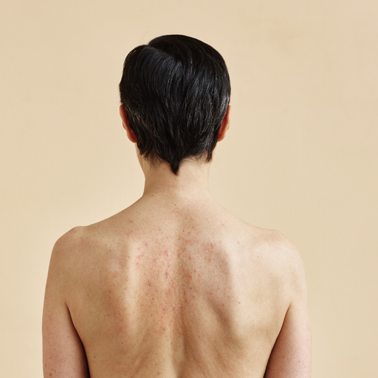 Comment éviter l’acné après le sport