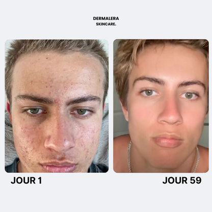 Savon Purifiant Anti Acne Après Sport