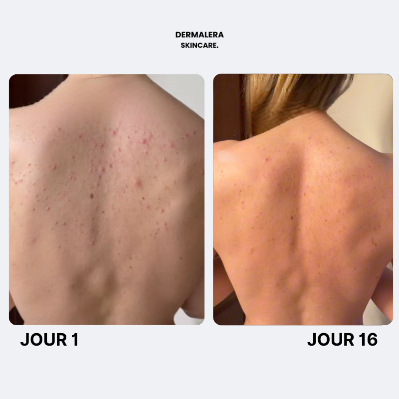 Savon Purifiant Anti Acne Après Sport