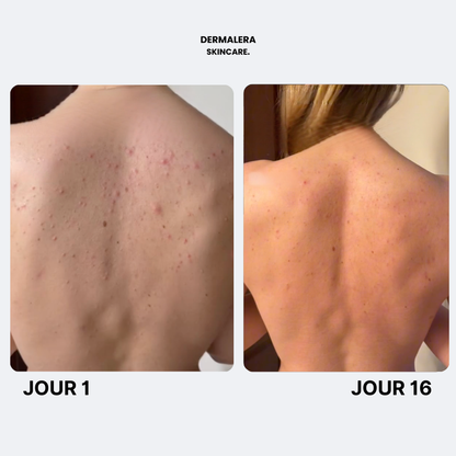 Savon Purifiant Anti Acne Après Sport