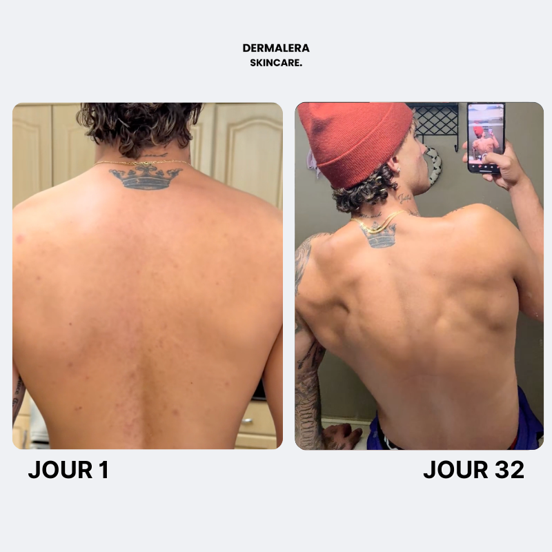 Savon Purifiant Anti Acne Après Sport