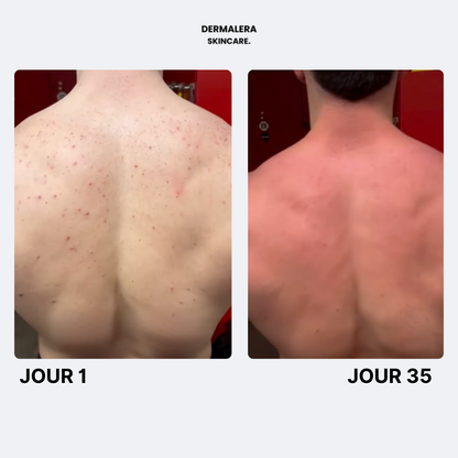 Savon Purifiant Anti Acne Après Sport