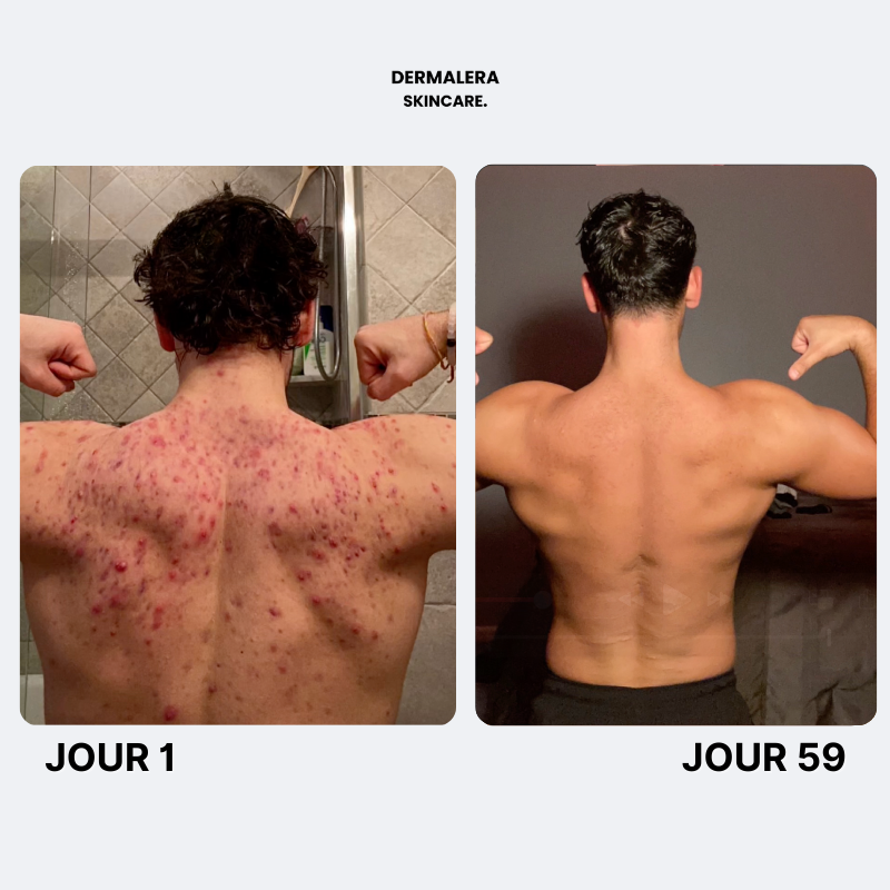 Savon Purifiant Anti Acne Après Sport