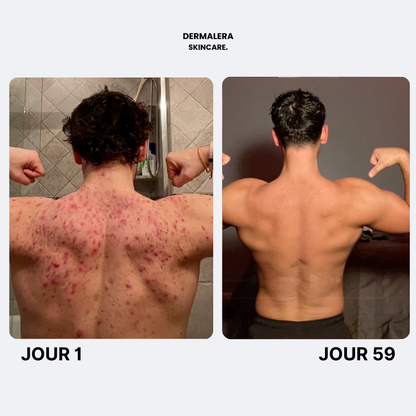 Savon Purifiant Anti Acne Après Sport