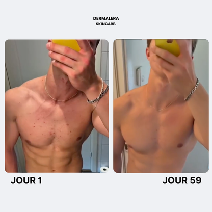 Savon Purifiant Anti Acne Après Sport